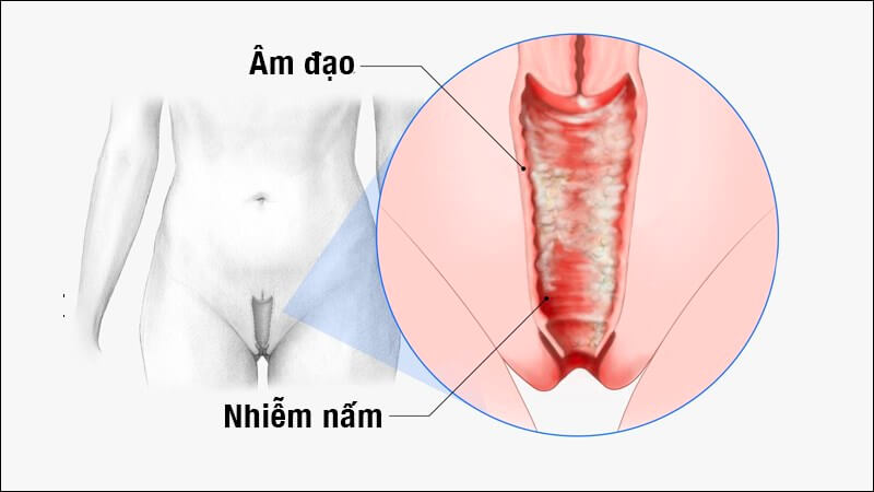 Viêm âm đạo do nấm Candida vùng kín: Nguyên nhân, triệu chứng