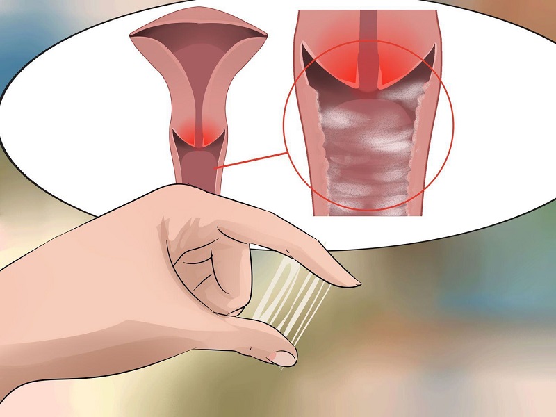 Ra khí hư bị vón cục như bã đậu là dấu hiệu bệnh gì? Nguy hiểm không?