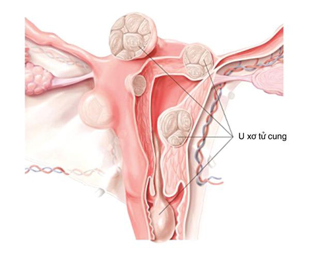 Tác động của u xơ tử cung đến lượng máu kinh nguyệt