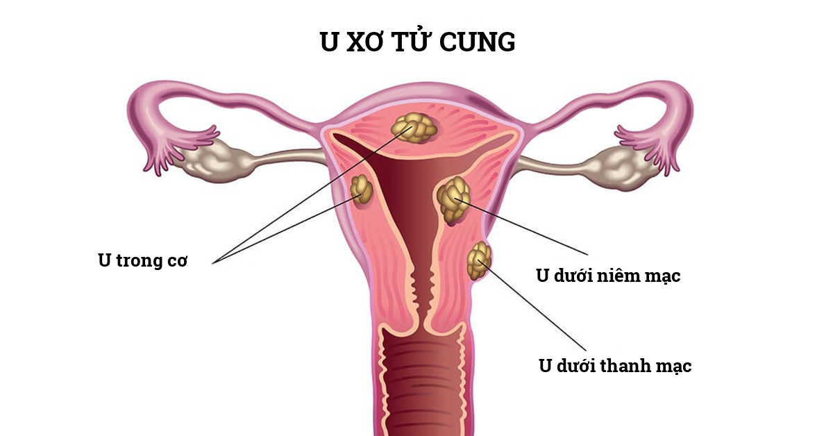 Các biện pháp giảm thiểu mất máu trong phẫu thuật bóc u xơ tử cung