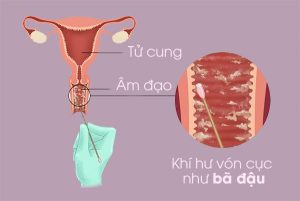 Ra khí hư bị vón cục như bã đậu là dấu hiệu bệnh gì? Nguy hiểm không?