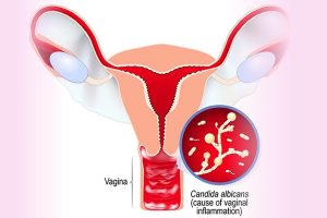 Viêm âm đạo do nấm Candida vùng kín: Nguyên nhân, triệu chứng