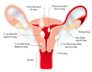 U xơ tử cung kích thước bao nhiêu thì mổ? Thực hiện khi nào?